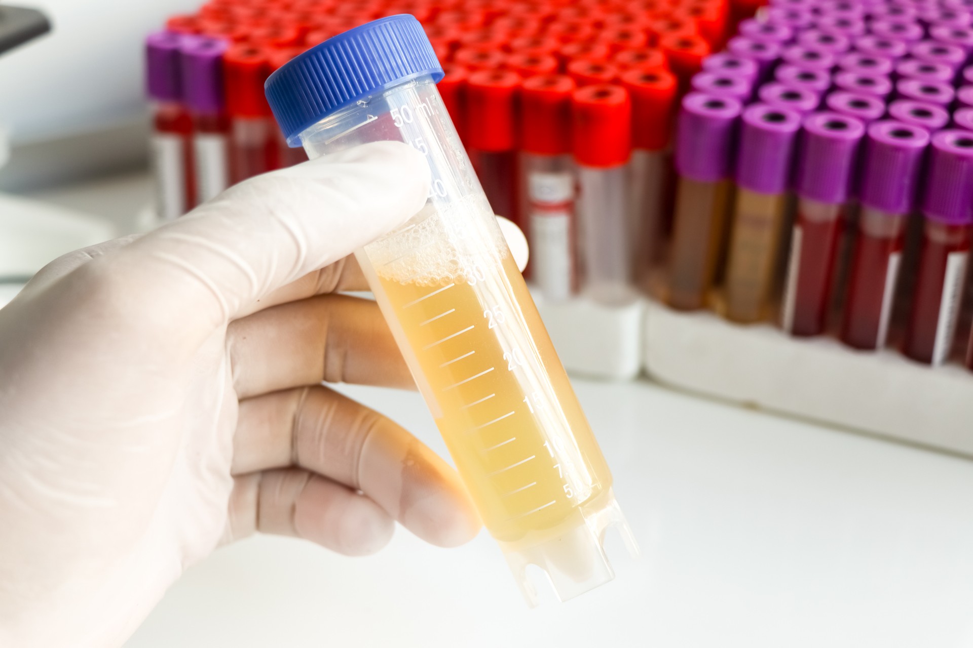 Urine test to look for abnormalities from Urine,  Urine sample to analyze in the laboratory