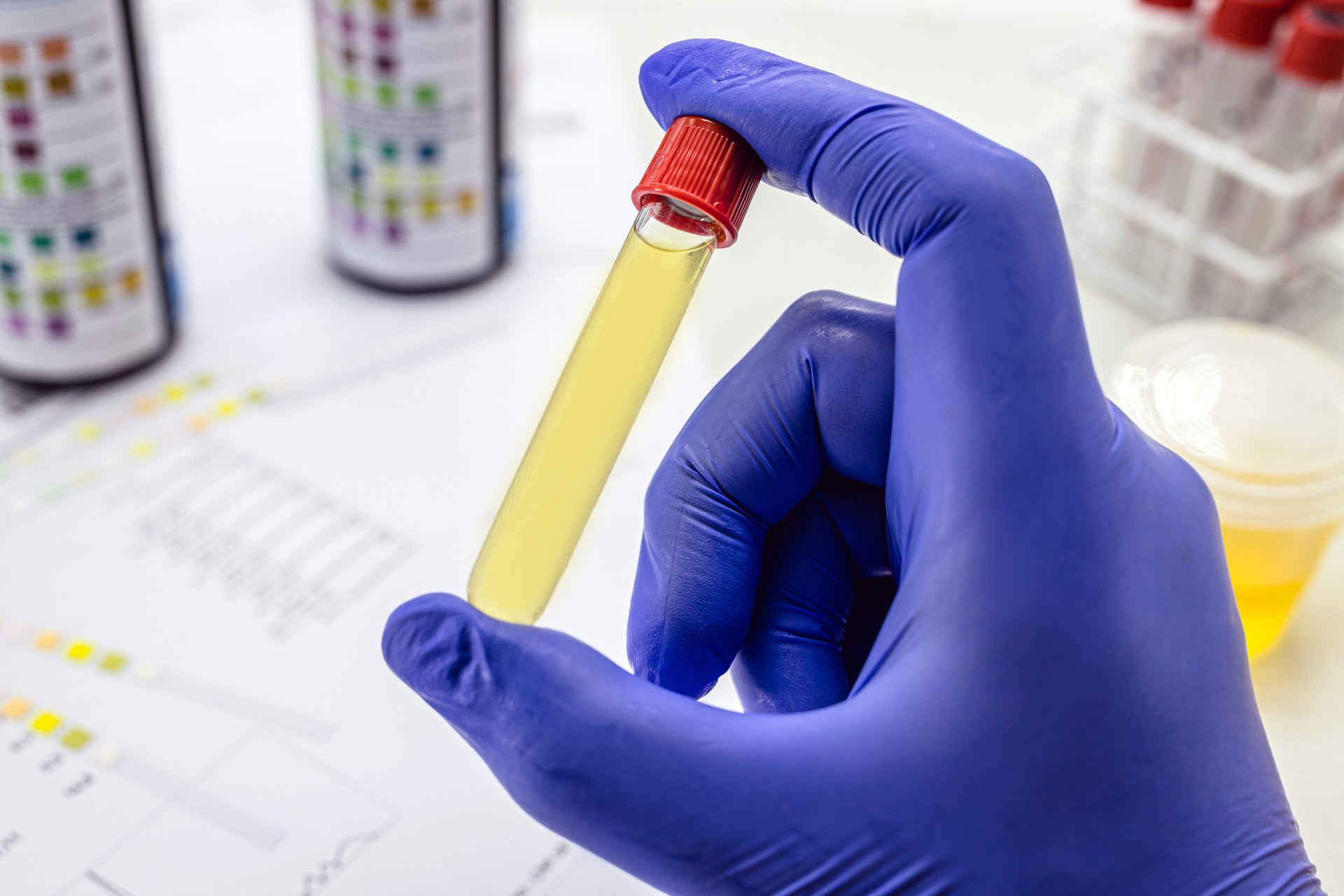 urine bottle held by healthcare professionals with latex glove, toxicology test